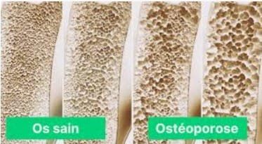 Ostéoporose : attention, ça fragilise le dos et la hanche