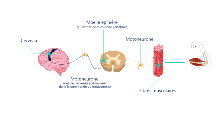 AVC et spasticité